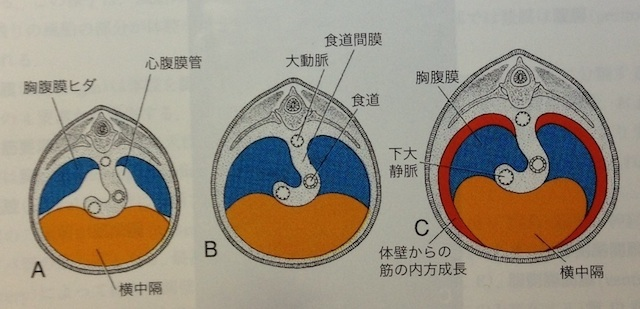 先天性横隔膜ヘルニア