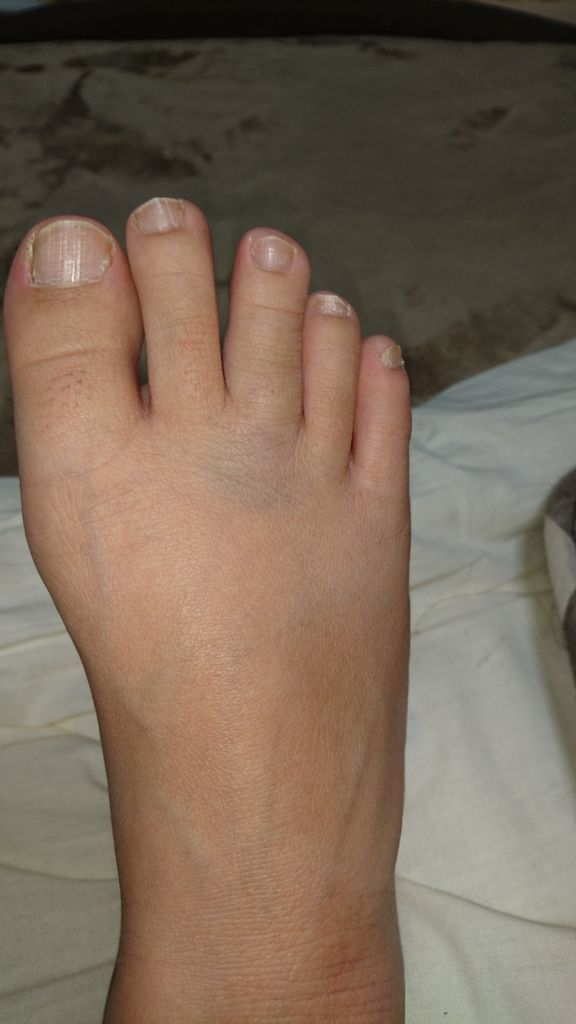 足の指 骨折