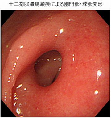 ときには、幽門部を塞いでしまって、食べ物の通りが悪くなったりもする