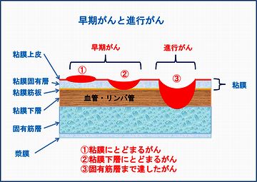 膵臓と肝臓のがんは、症状が出てからじゃ、そうとう進行してると聞きます
