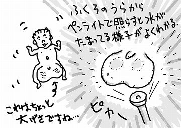 陰嚢水腫は、入ってるのが水だから透明なの