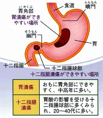 あのころ、十二指腸潰瘍を患ってた