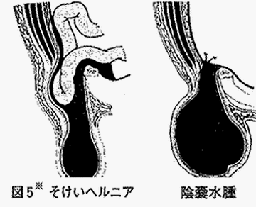 見た目、脱腸と紛らわしいんじゃないの?