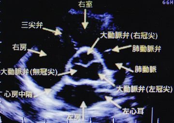 その後、心臓エコーってやつ