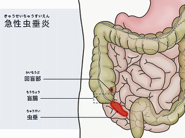 盲腸は助からない