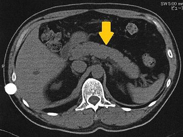 矢印が膵臓です