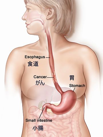 ひょっとしたら、食道癌じゃないかと思って……