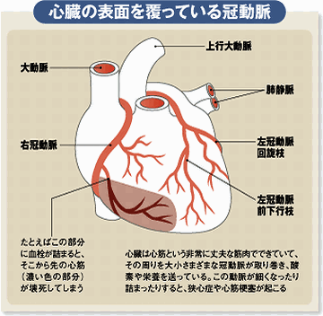 MRIでは、『冠動脈硬化』って書いてあった