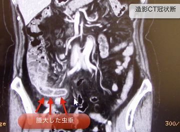 10代から20代にかけては、この活動が活発になりすぎて、炎症反応が引き起こされることがあるわけ