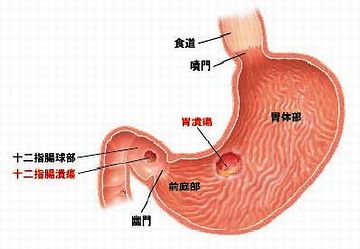 十二指腸潰瘍ね