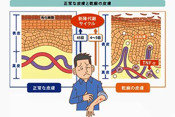 尋常性乾癬って病気は、皮膚の新陳代謝が早くなりすぎる病気なのよ