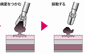 カメラに付いたハサミで組織を切り取って来る