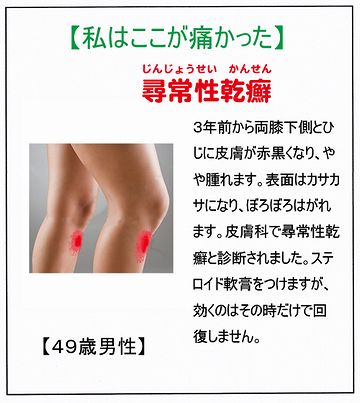 尋常性乾癬って云う