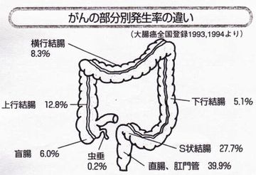 S字結腸癌だったかな