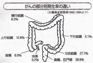 Ｓ字結腸癌だったかな