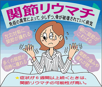 自己の免疫が手足の関節を侵し、これにより関節痛、関節の変形が生じる代表的な膠原病