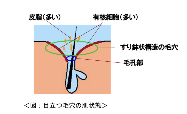 Mimi流 鼻の毛穴ケア 毛穴が目立つ原理 不全角化 とは ベビーオイル洗顔 Mimiのインテリジェンスケア