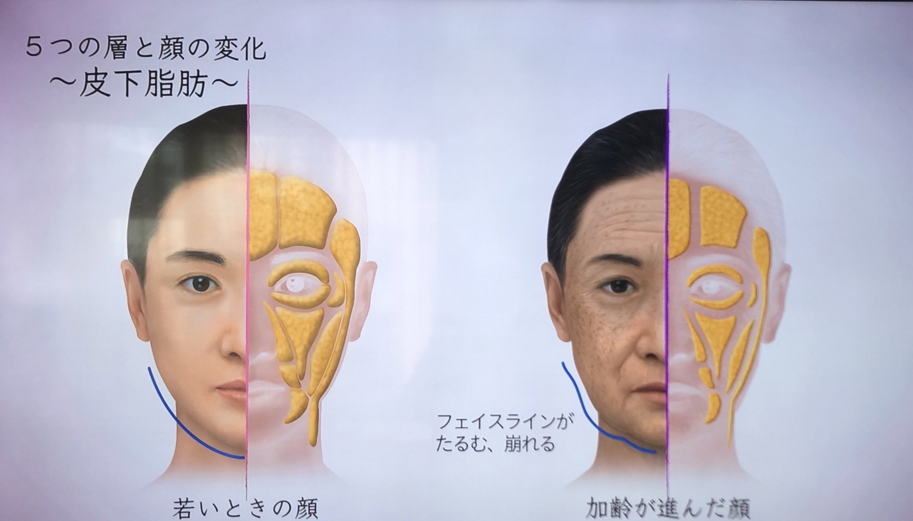 顔の老け はどこからやってくる スキンケアでできること 美容医療でできること ベビーオイル洗顔 Mimiのインテリジェンスケア 顔の老け はどこからやってくる スキンケアでできること 美容医療でできること ベビーオイル洗顔 Mimiのインテリジェンスケア