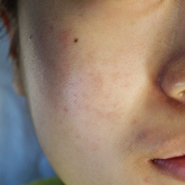 何をしても綺麗にならないお肌に ハーブリプロのご紹介 Salon De Mimosa