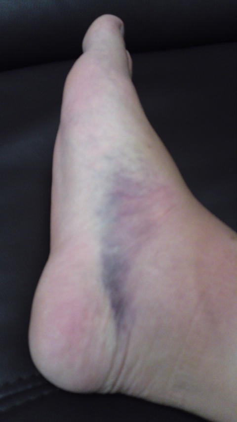 剥離骨折 モトザレワールドxx