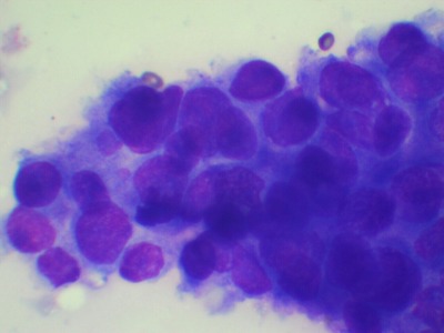 FNA(アポクリン腺癌)