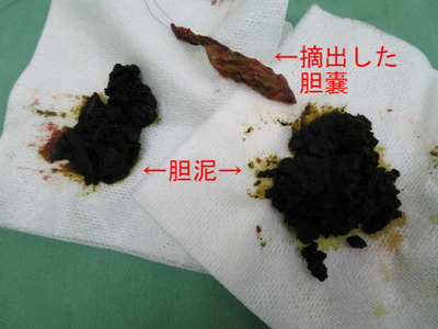 胆嚢摘出