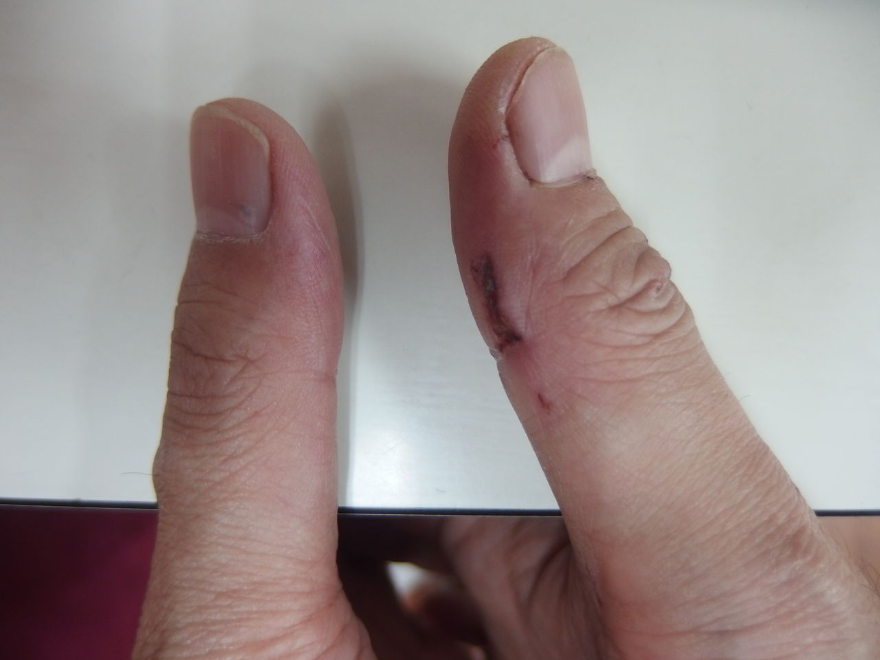 獣医師と手の傷と 風の動物病院のブログ