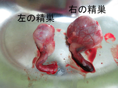 悪性精上皮腫・ライディッヒ細胞腫