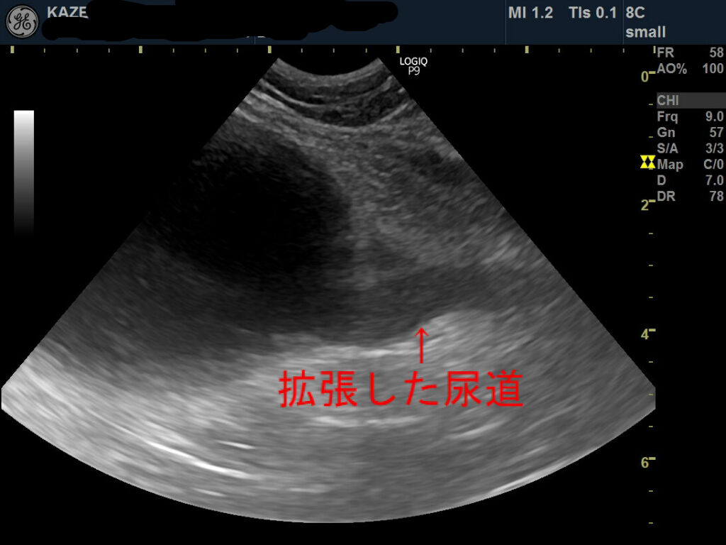 予防 腎盂 腎炎