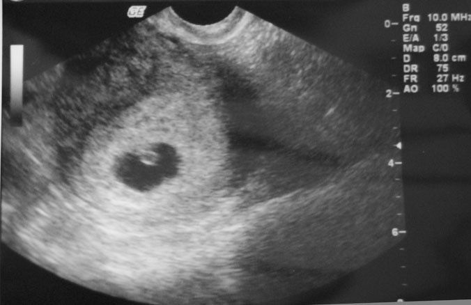 胎児心拍確認 妊娠6週2日 夫がガンになった