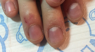 深爪施術前