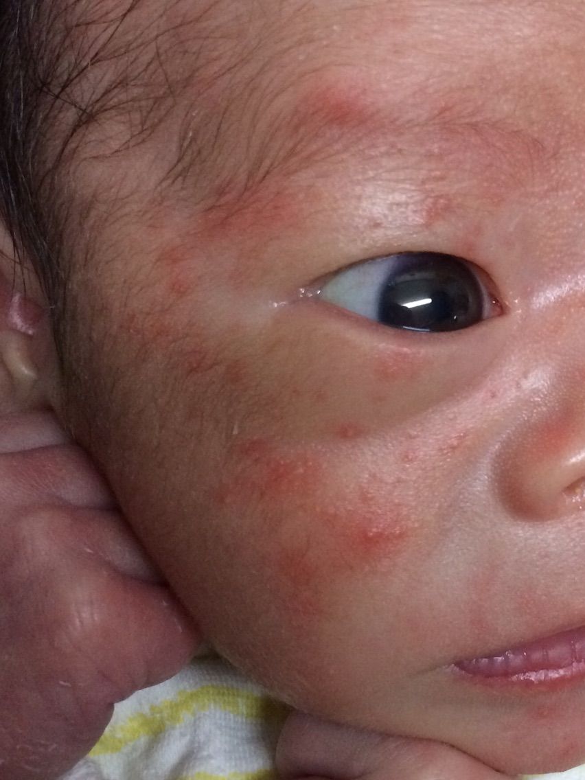 顔 乳児 湿疹