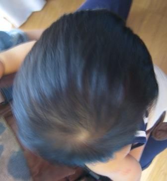 幼児の頭の歪み Hitomi 幼児の頭の歪み Hitomi