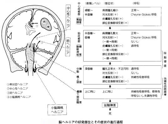 徐 脳 硬直