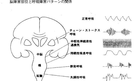 脳ヘルニア メモ帳 脳ヘルニア メモ帳