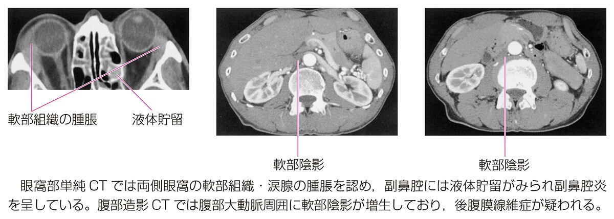 Igg4関連疾患 副鼻腔炎 涙腺炎 顎下腺炎 後腹膜線維症 落書き帳2 Igg4関連疾患 副鼻腔炎 涙腺炎 顎下腺炎 後腹膜線維症 落書き帳2