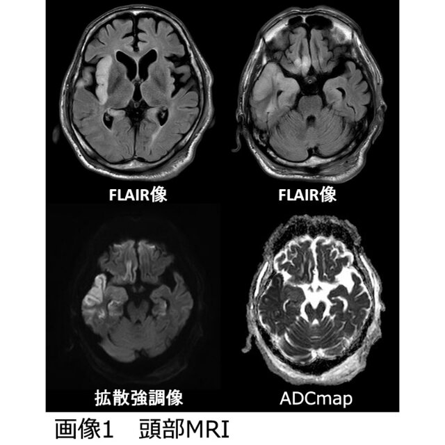 ヘルペス脳炎 落書き帳2