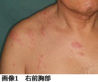帯状疱疹後肉芽腫 落書き帳2 帯状疱疹後肉芽腫 落書き帳2