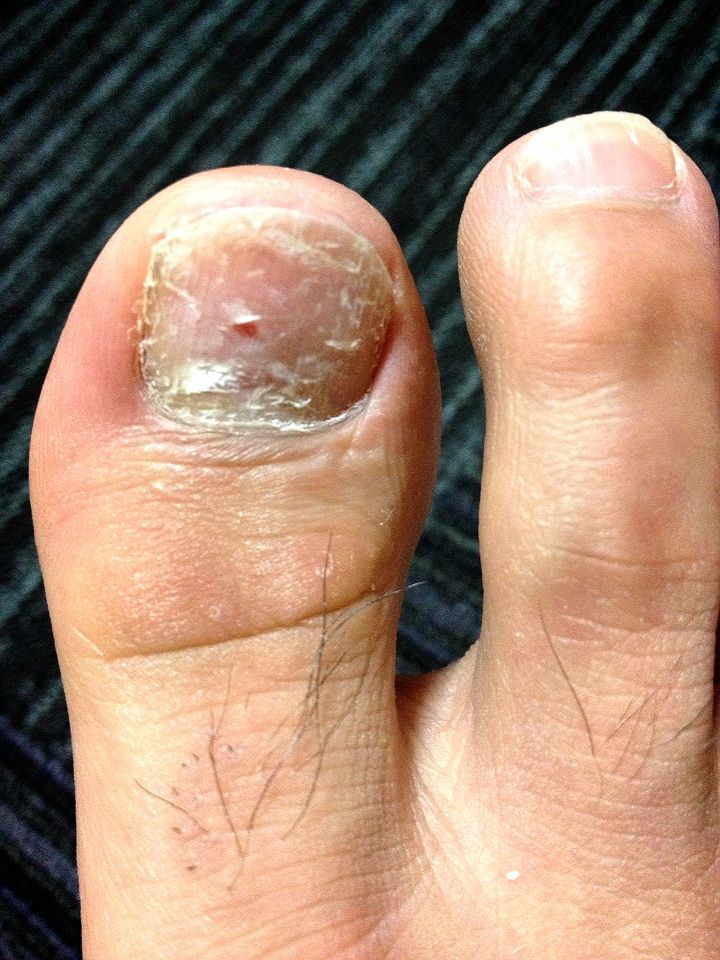 12 2 4 爪削り 爪白癬野郎