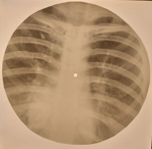 肋骨レコード : 燃えるゴミは明日