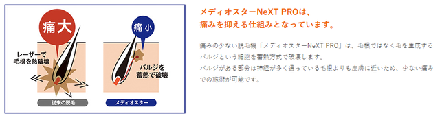 【ゴリラ脱毛】ヒゲから解放された生活を目指して-痛み