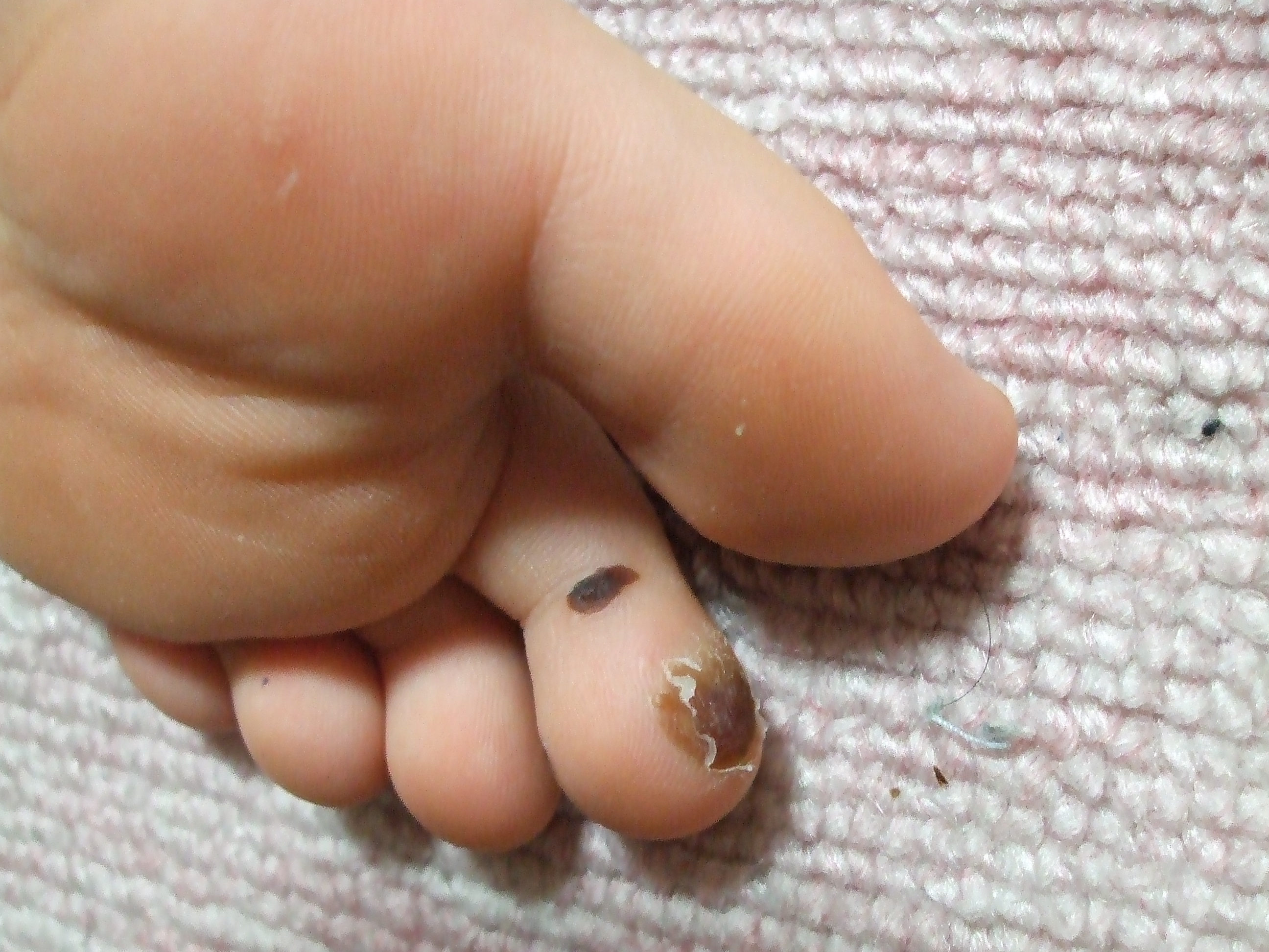 Moe イボの凍結療法中です！ : Moeとお父さんの父子家庭日記