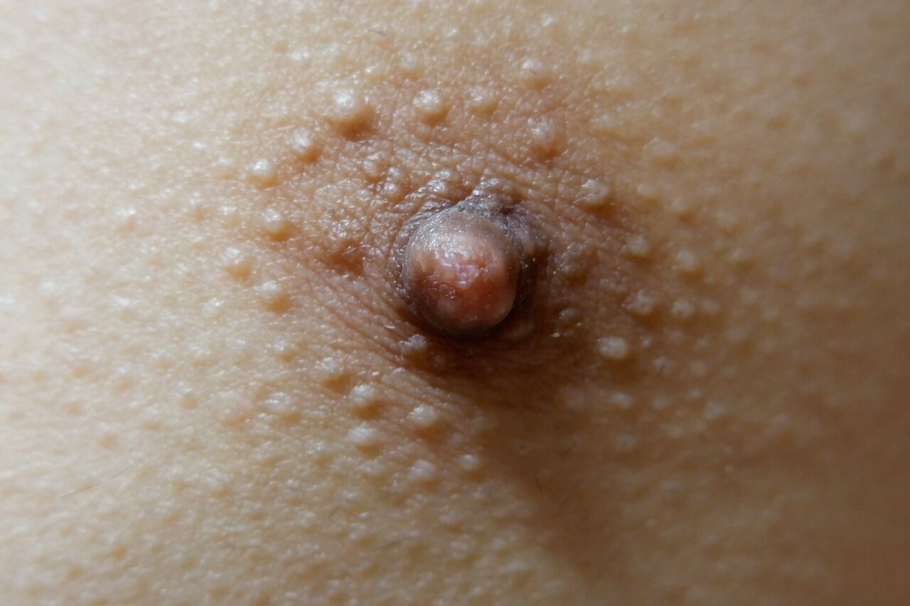 変乳首 円皮鍼で乳首開発（３） : しぇるの性感開発日記