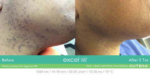 excelHR-M_Aggarwal_Neck