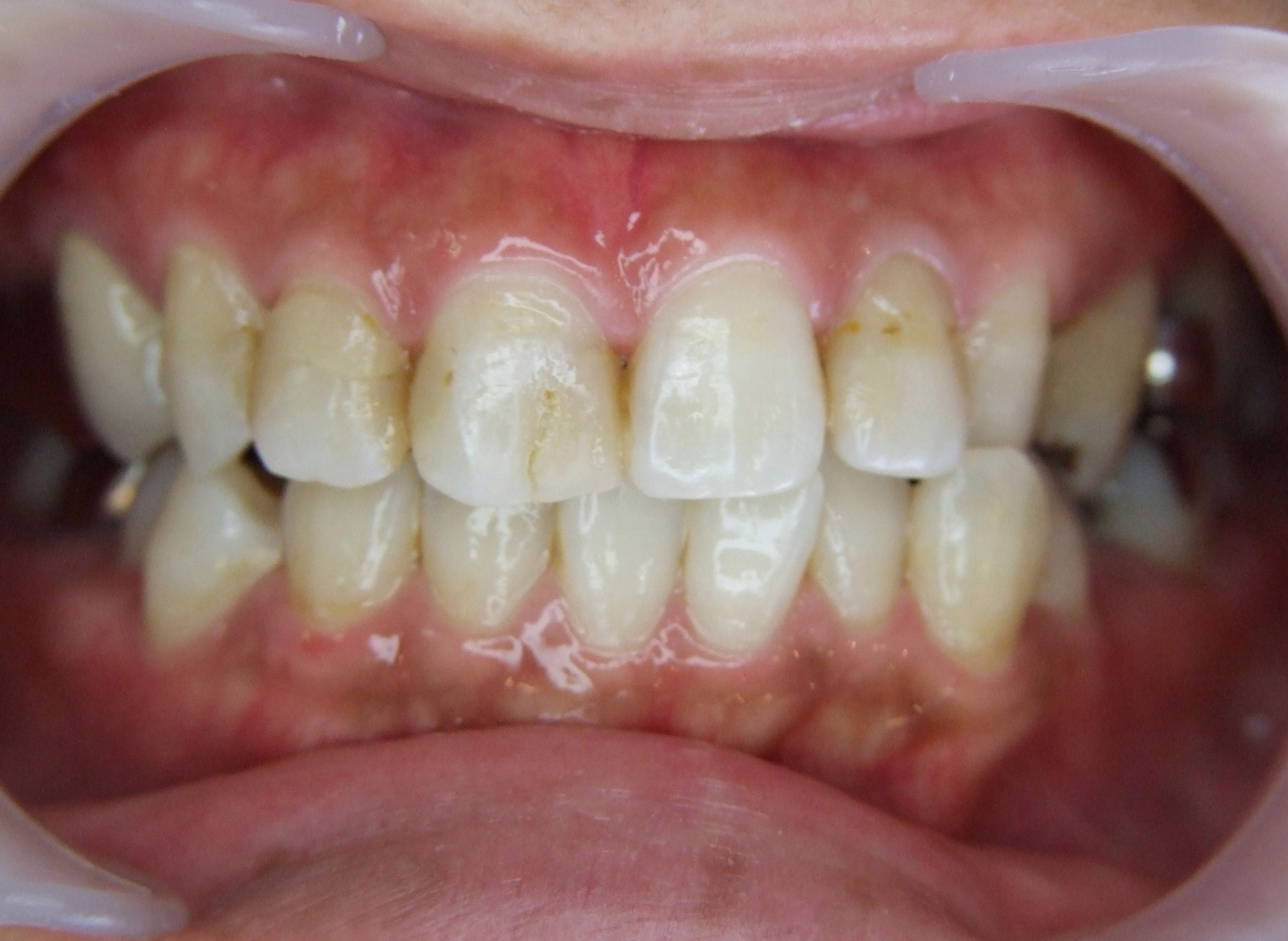 ボンディットレストレーションによる審美修復 もりた歯科クリニック