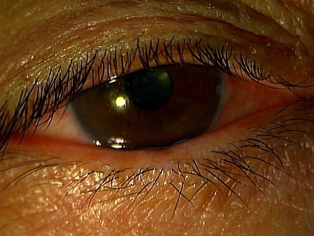 ミドリンpアレルギー もりや眼科 森谷充雄が眼科の事を分かりやすく説明します