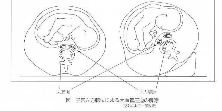肥満 双胎 トロント産科麻酔 小児麻酔研修の記録 肥満 双胎 トロント産科麻酔 小児麻酔研修の記録