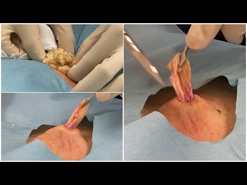 巨大化した粉瘤の摘出動画が怖すぎる まとめも