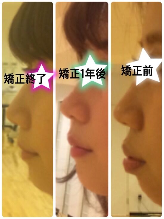 画像 歯列矯正をやった結果がスゴすぎｗｗｗｗ まとめも