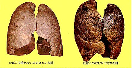 喫煙肺